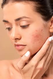 moisturizers for acne-prone skin by Advik Ayurveda