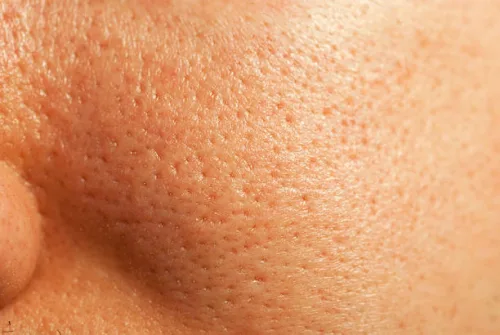 Pores Treatment by Advik Ayurveda