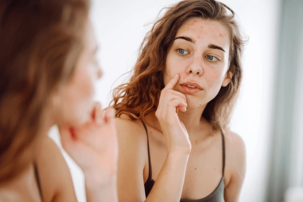 Treat dull skin naturally by Advik Ayurveda