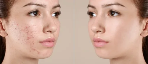 ayurvedic solutions for acne by Advikayurveda