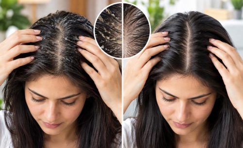 natural ingredients for scalp detox